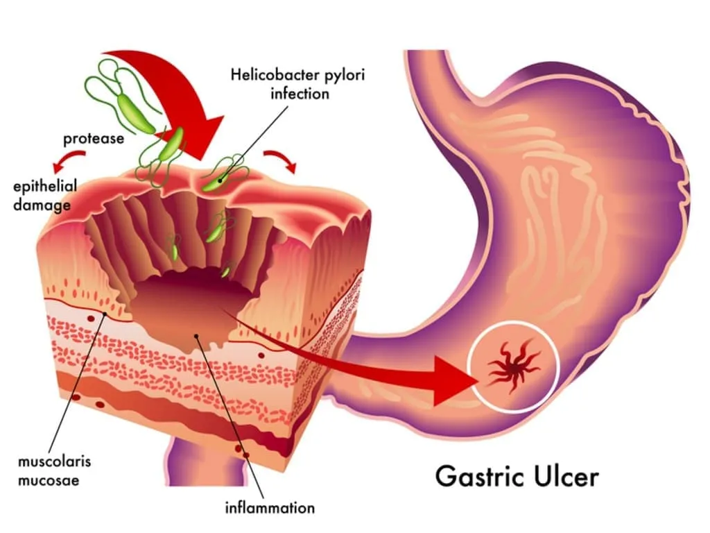 Helicobacter pylori. Як вчасно виявити та ефективно лікувати?