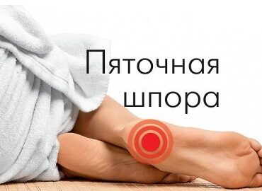 Пяточная шпора - 💯% скидка на первую процедуру!