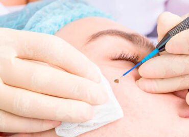 Удаление родинок на лице радиоволновым методом