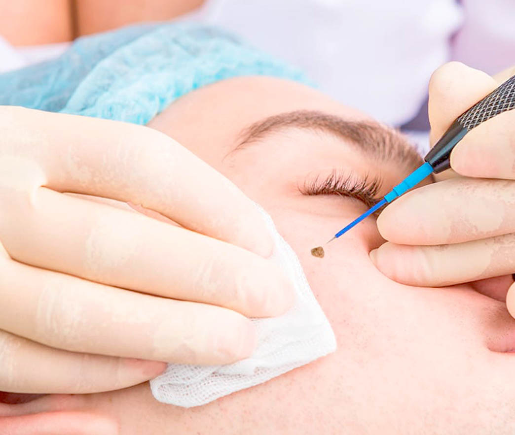 Удаление родинок на лице радиоволновым методом