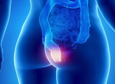 Парапроктит - Как вовремя распознать и предотвратить осложнения