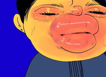 Ангіоневротичний набряк — Симптоми та перша допомога