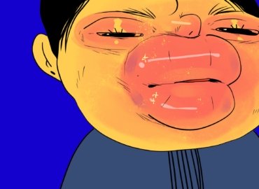 Ангионевротический отек — Симптомы и первая помощь