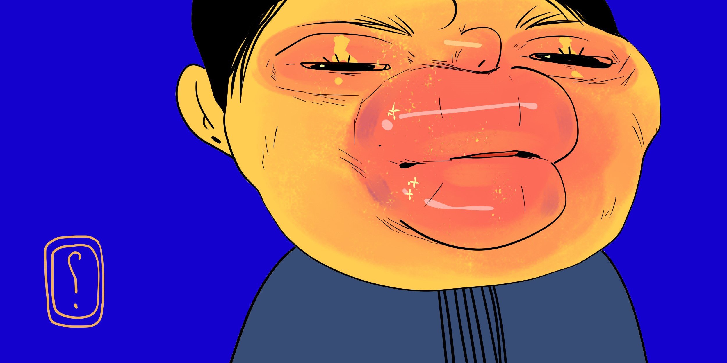 Ангіоневротичний набряк — Симптоми та перша допомога