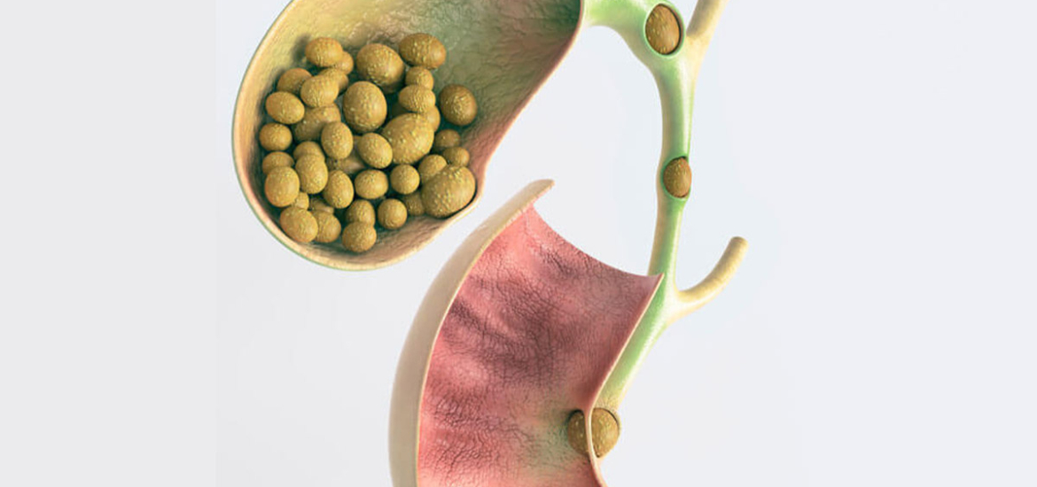 Фото: Лікування жовчнокам'яної хвороби