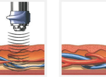 Ударно-волновая терапия в урологии - Инновационный метод лечения