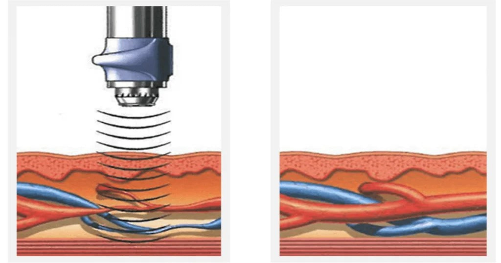Ударно-волновая терапия в урологии – Инновационный метод лечения