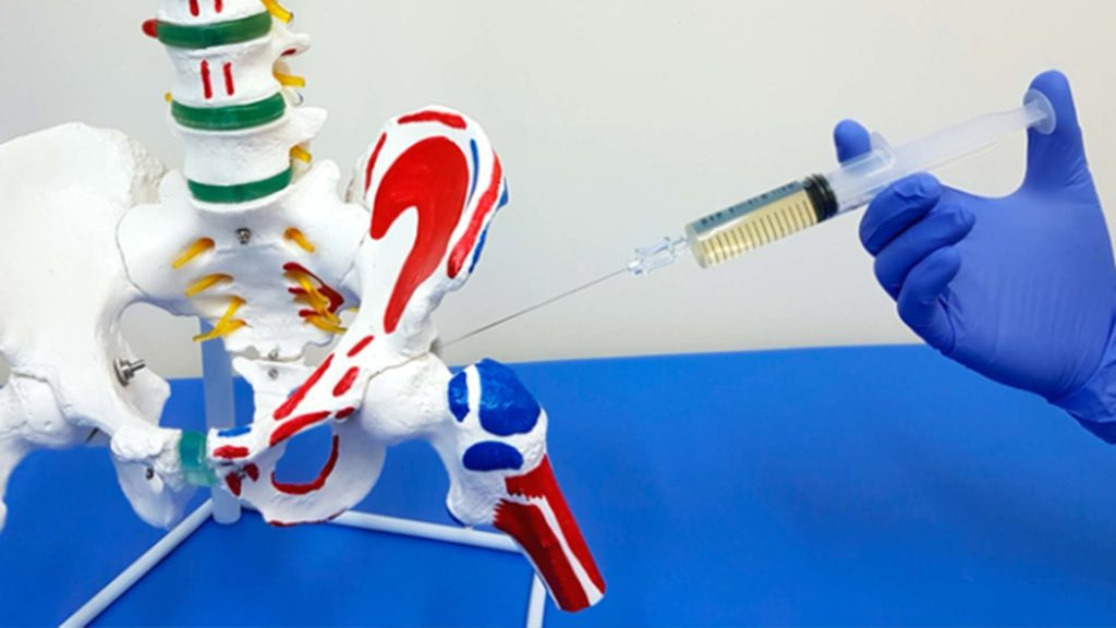 Укол у тазостегновий суглоб – Унікальна пропозиція від нашого медичного центру!