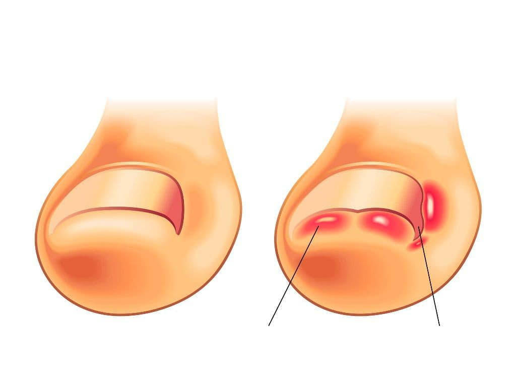 Оніхокриптоз – Питання, які важливо поставити хірургу