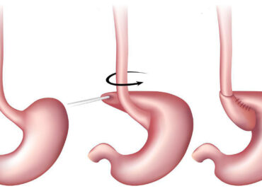 Рефлюксная болезнь - Все, что вам нужно знать о причинах и лечении