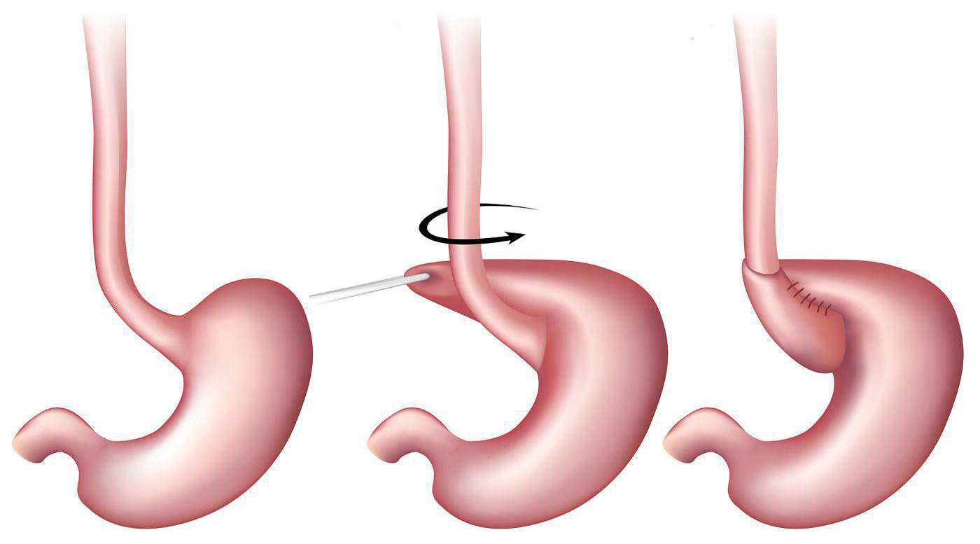 Рефлюксна хвороба — Все, що вам потрібно знати про причини та лікування