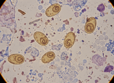 Аскаридоз: симптомы, современная диагностика и эффективное лечение в Киеве