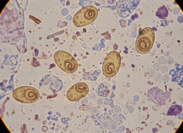 Аскаридоз: симптомы, современная диагностика и эффективное лечение в Киеве